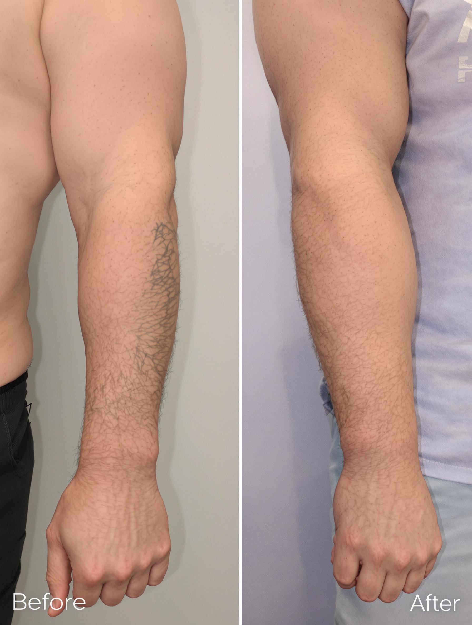 Photo avant/après montrant le relâchement cutané des bras après une perte de 40 kg