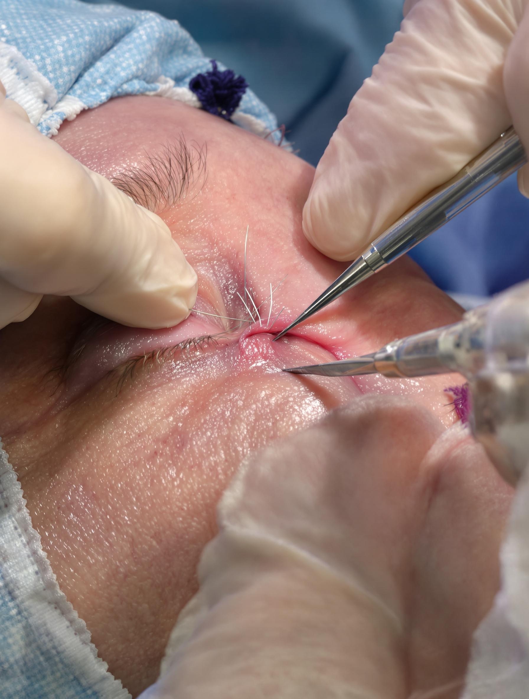 Sutures du canthus externe pour remonter la paupière inférieure lors d’une canthopexie