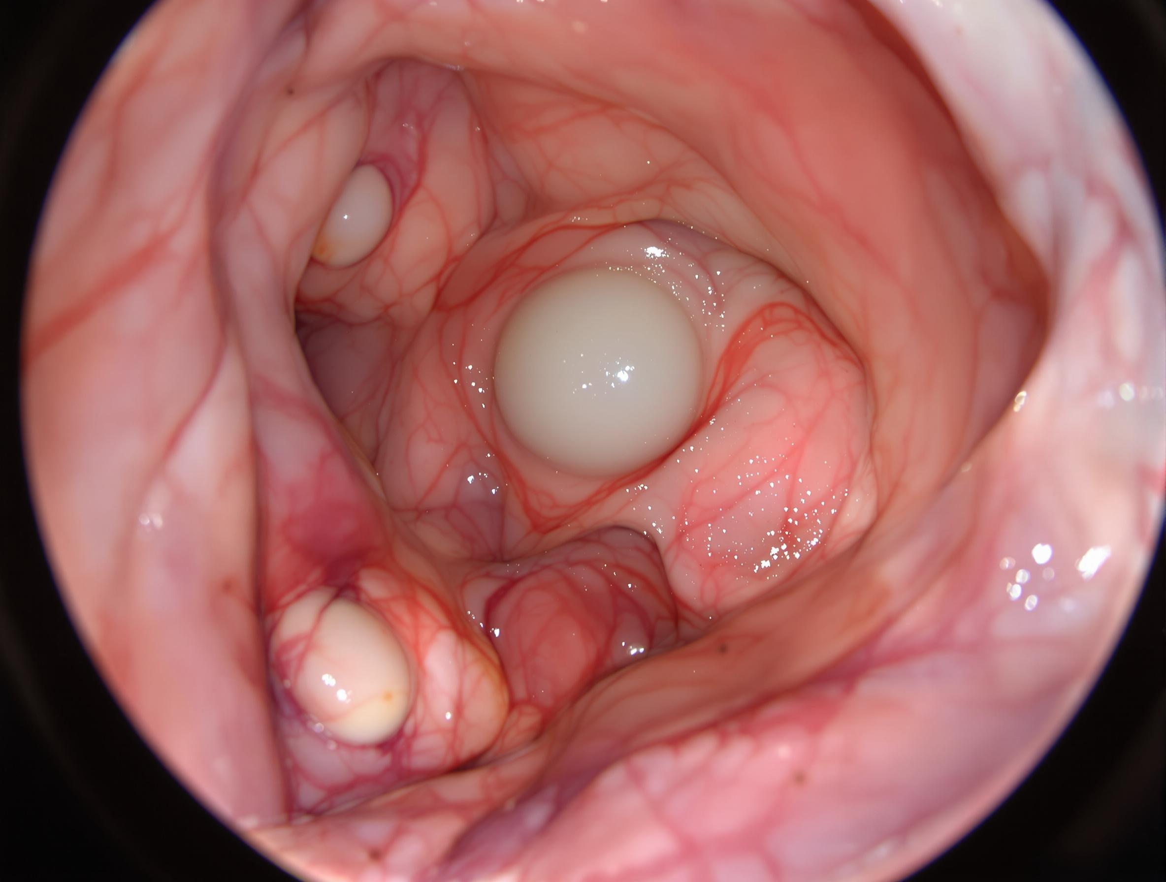 Image d'une hystéroscopie montrant un polype endométrial