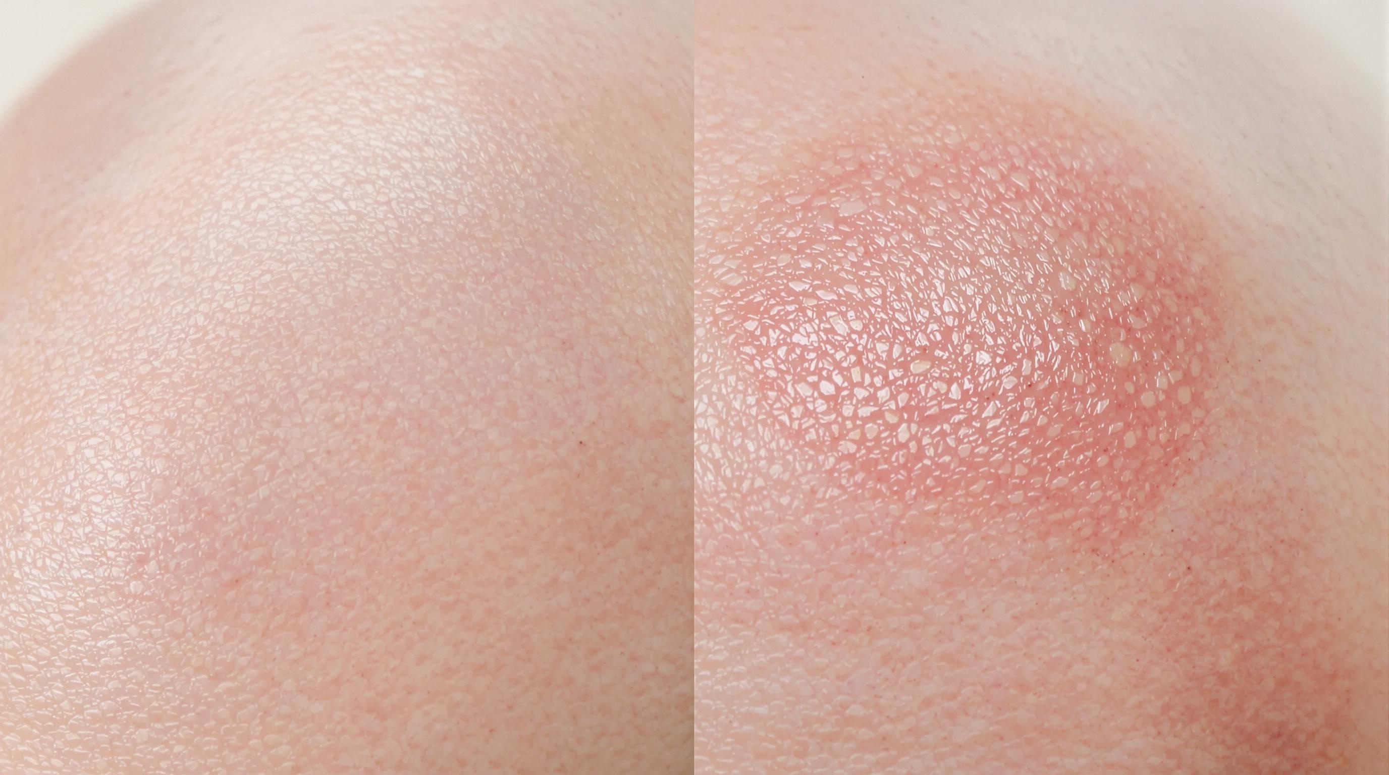Comparatif entre un cuir chevelu sain et irrité