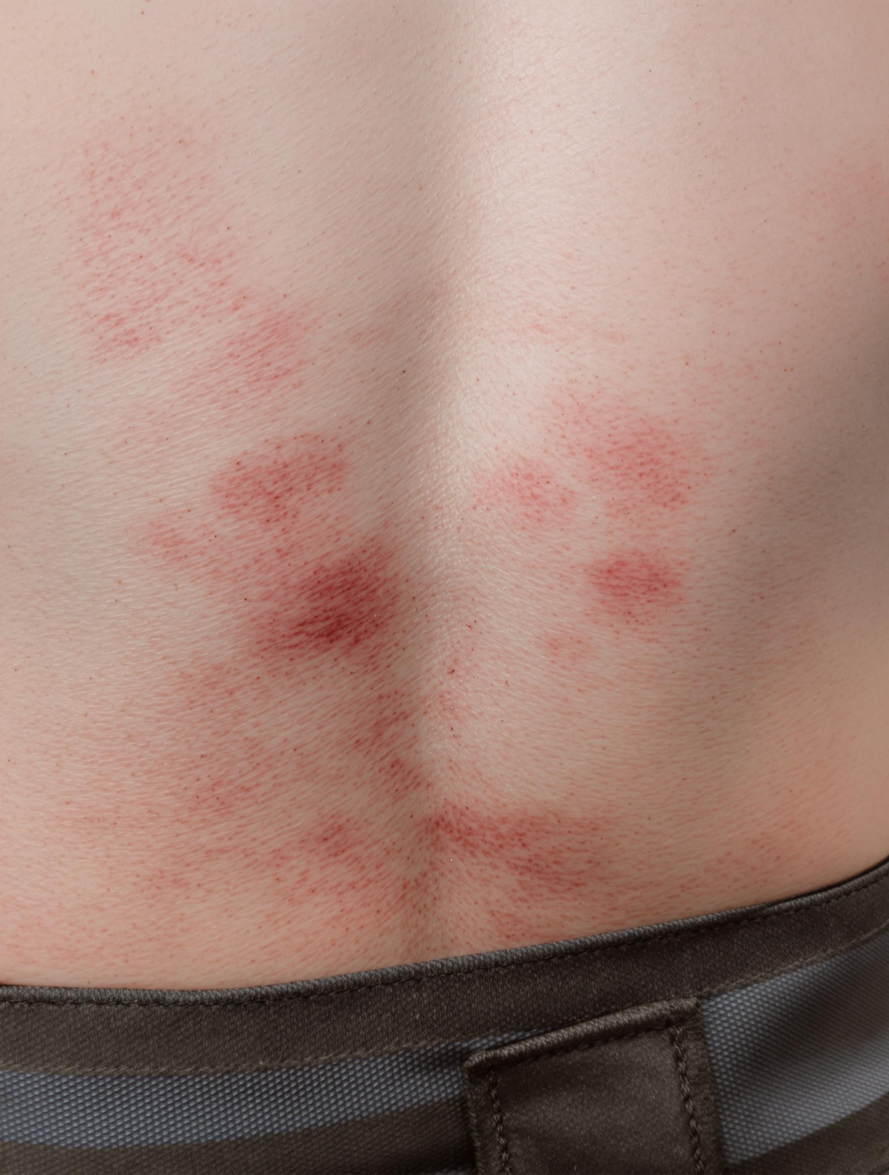 Irritation du dos provoquée par une ceinture lombaire