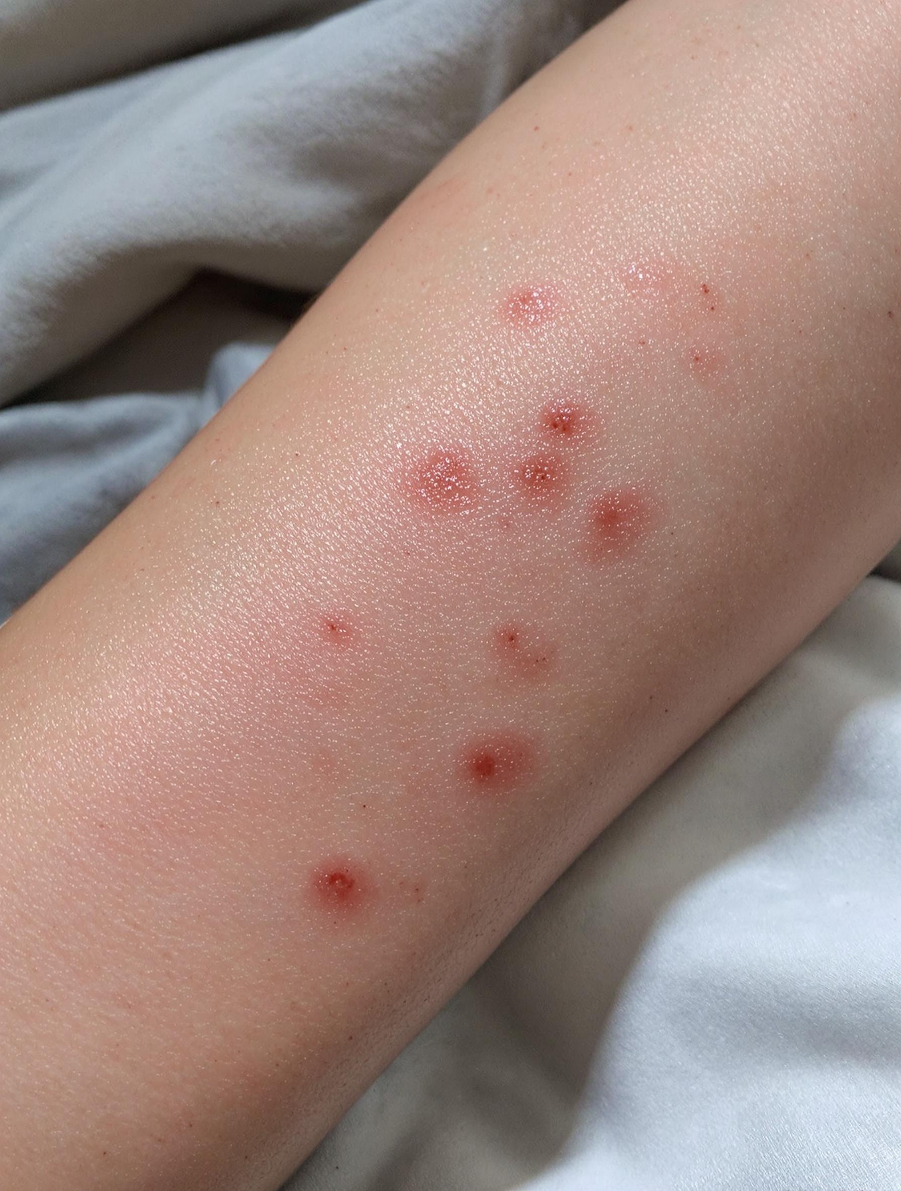 Boutons typiques de maculopapules rouges sur un bras, matelas contaminé