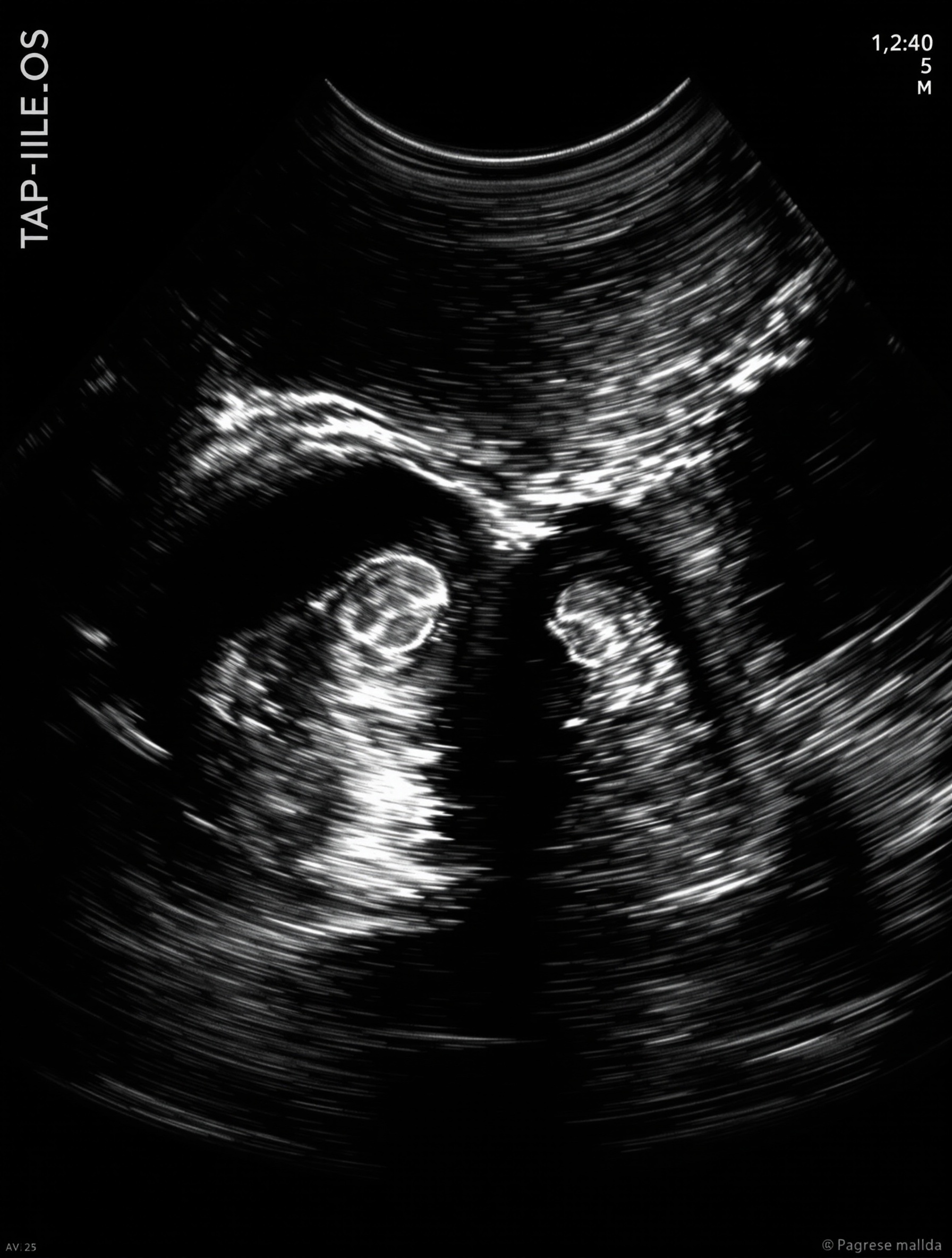 Échographie symbolique du jumeau évanescent dans une grossesse gémellaire
