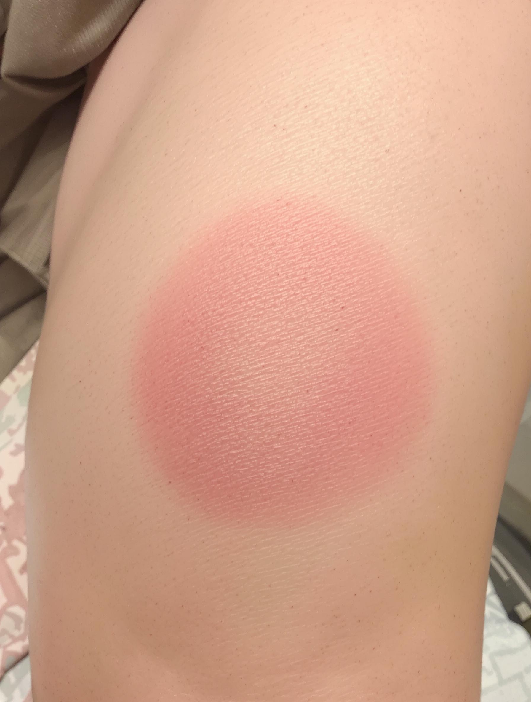 Rouge homogène 15 minutes après Tecar chez un coureur avec tendinite.