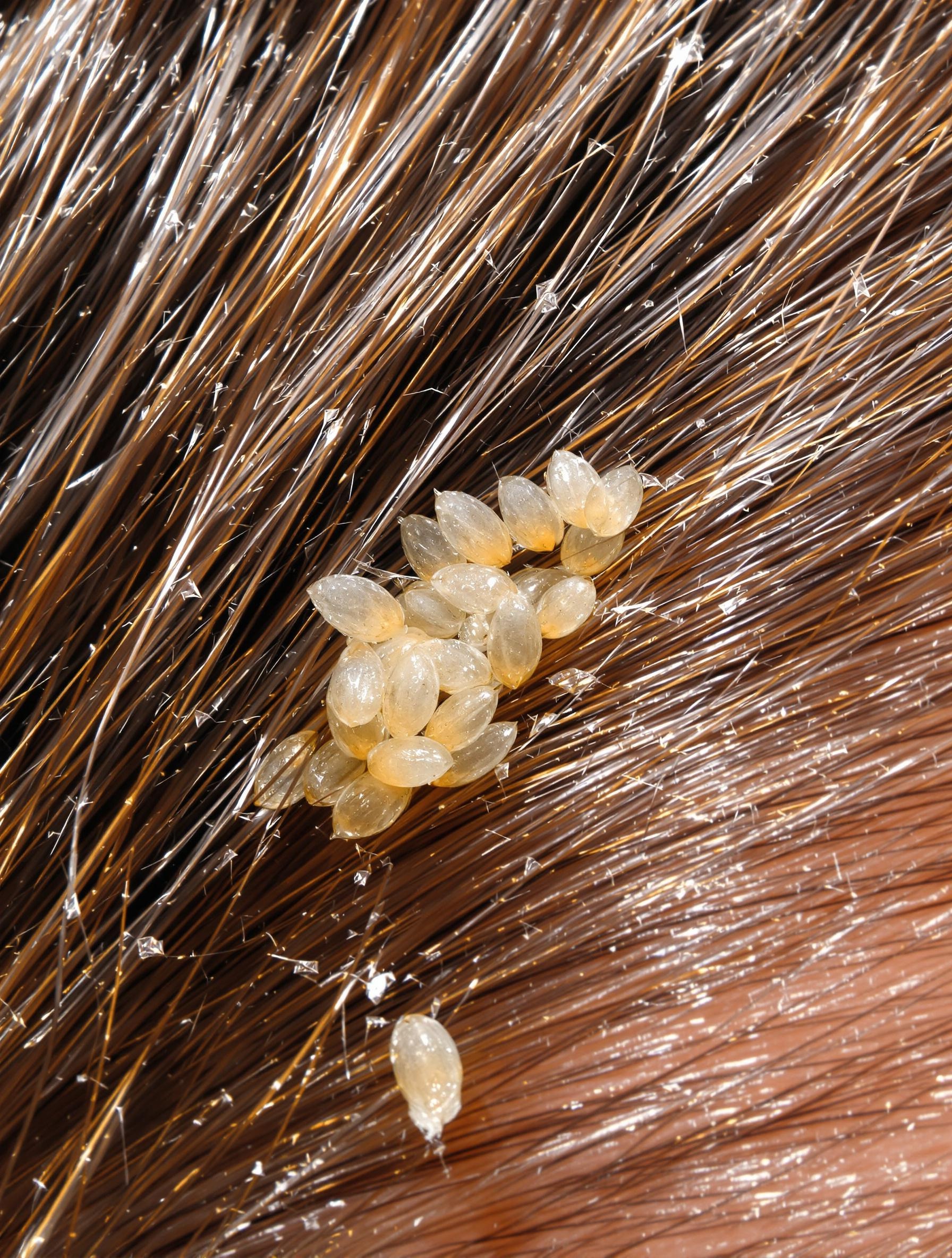 Vinaigre Blanc Pour Les Poux Efficacit Mode D emploi Et Vinaigre Blanc Pour Les Poux Efficacit Mode D emploi Et