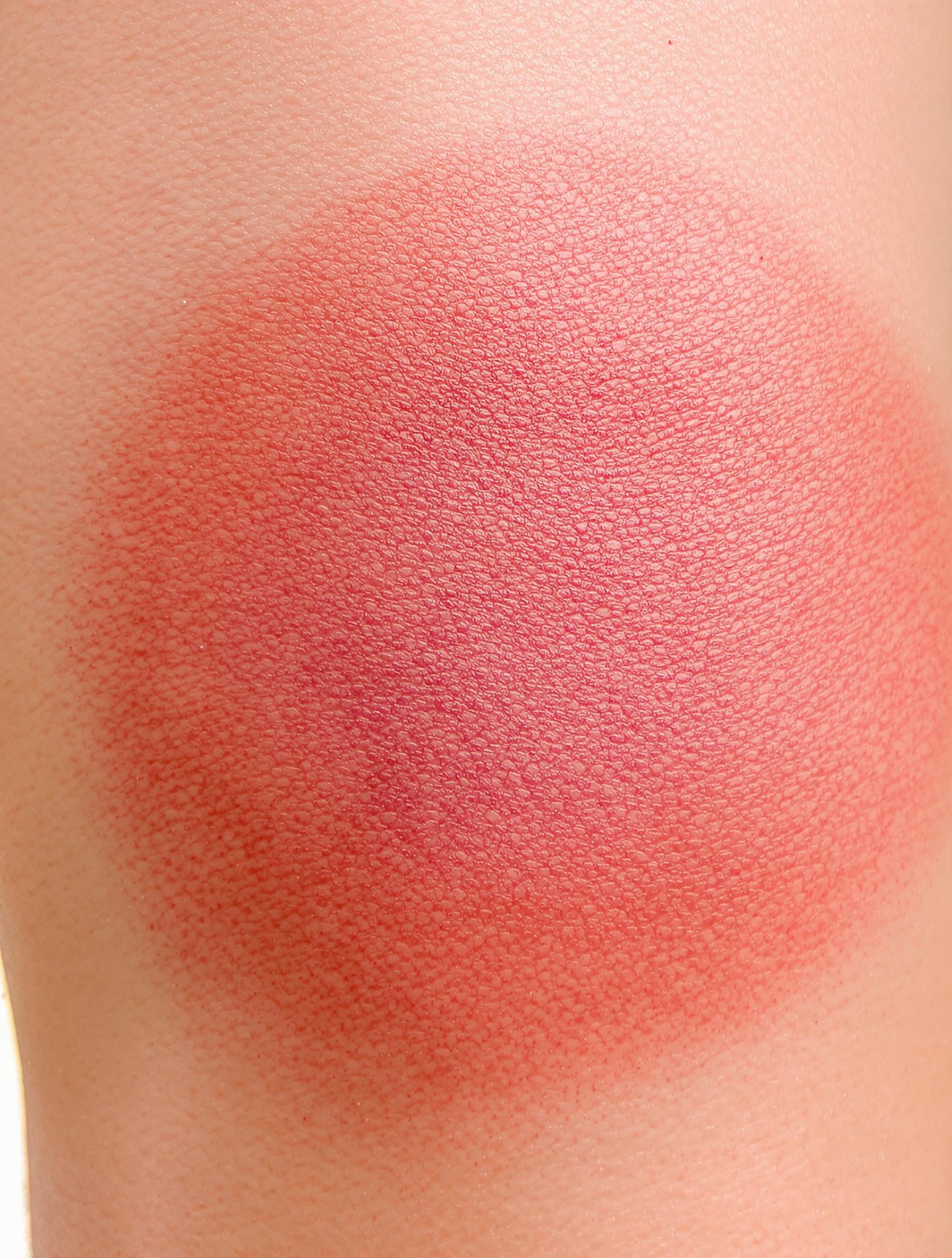 Ecchymose profonde causée par un massage excessif en madérothérapie