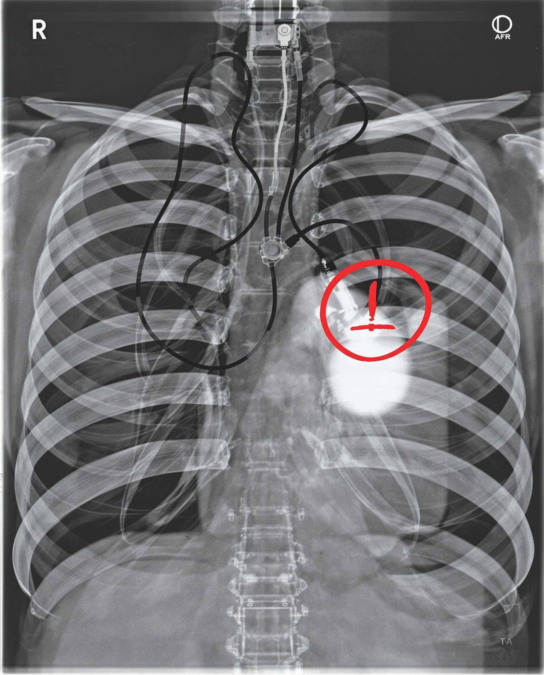Implant électronique incompatible avec Tecar – zone à éviter.