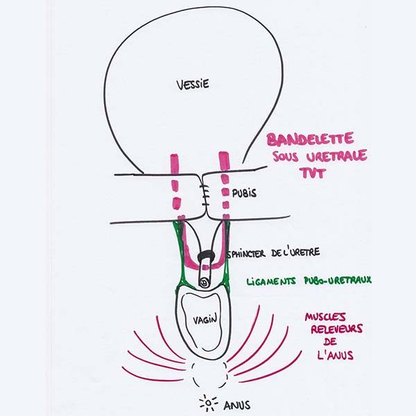 Schéma anatomique montrant le positionnement précis d'une bandelette sous-urétrale.