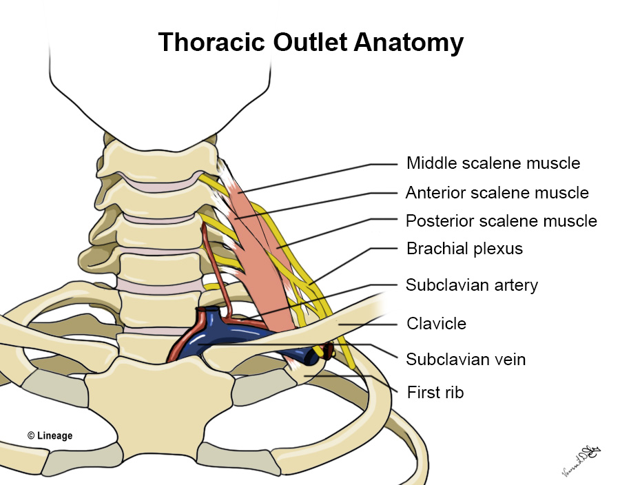 Schéma anatomique du défilé thoraco-brachial : plexus brachial et vaisseaux sous-claviers passant entre muscles scalènes et clavicule avec zone de compression mise en évidence.