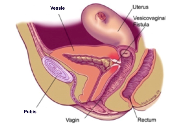 Schéma anatomique simple montrant la différence entre un rein sain et un rein atteint du syndrome de la jonction pyélo-urétérale. Bassinet dilaté et zone de rétrécissement visibles.