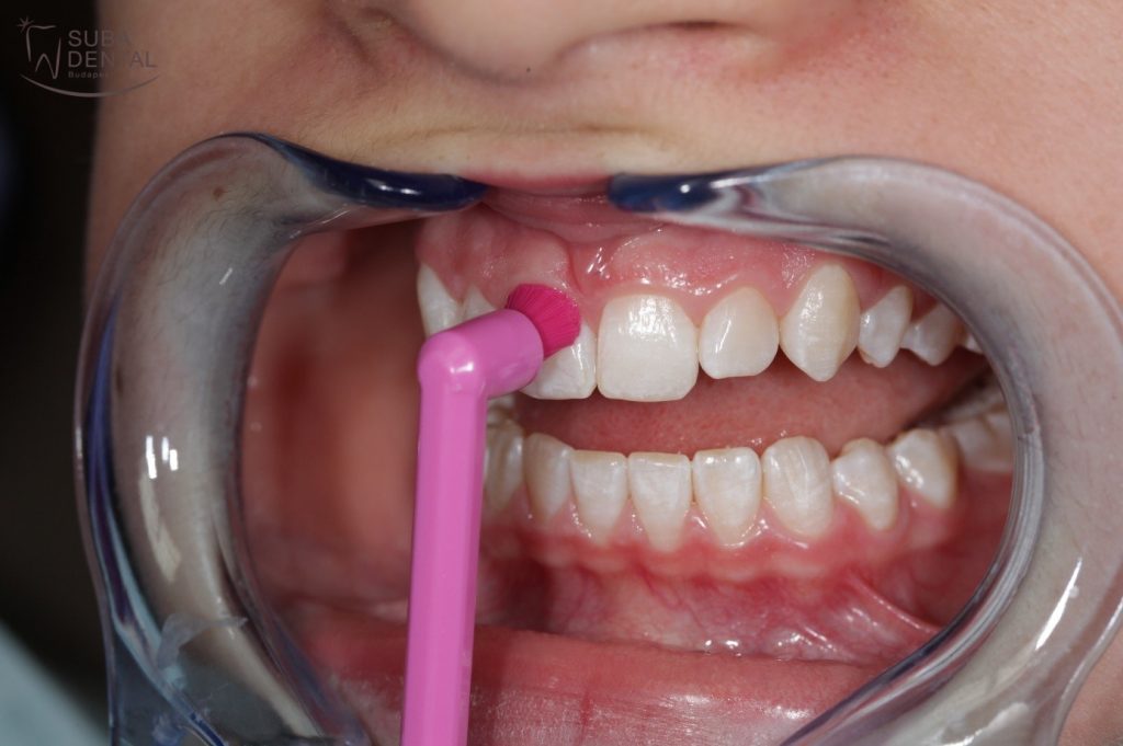 Utilisation correcte d'une brossette interdentaire autour d'un implant dentaire et sa couronne, schéma pédagogique.