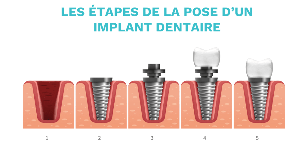Schéma des trois parties d'un implant dentaire : racine titane, pilier, couronne.