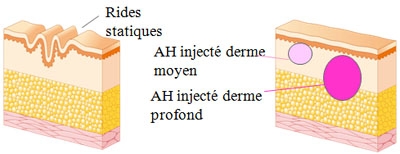 Schéma simplifié de l'épiderme après injection d'acide hyaluronique