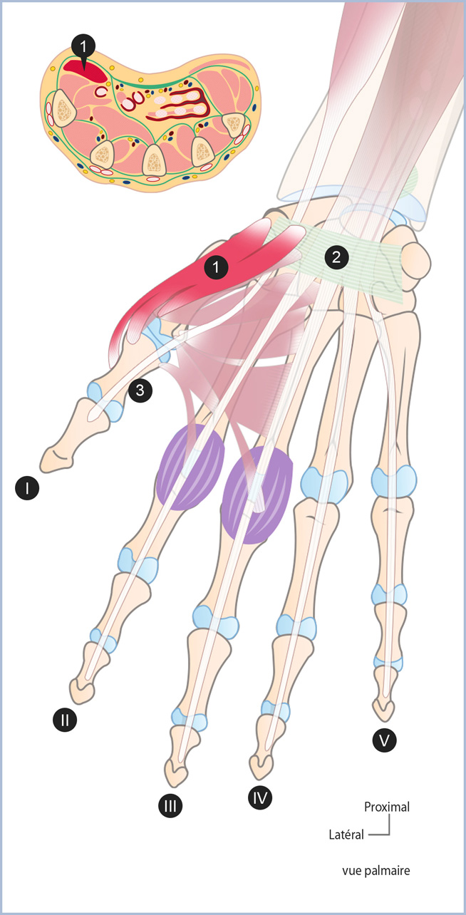 Schéma comparatif main saine vs atrophie éminence thénar