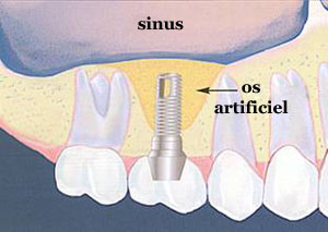 Schéma manque os sous sinus maxillaire pour implant