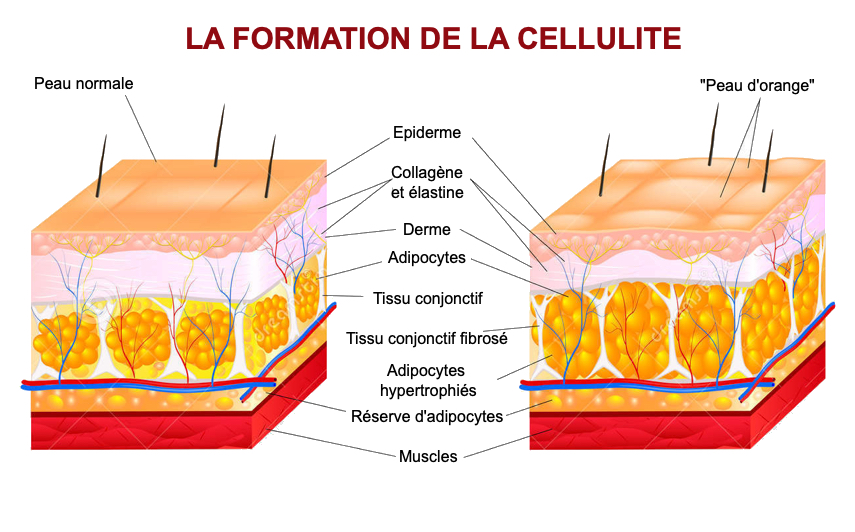 Schéma simplifié : peau, capitons, fibrose, adipocytes