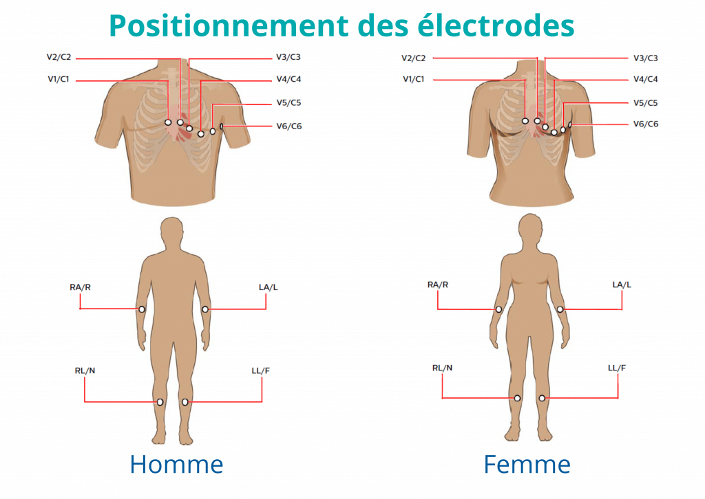 Positionnement des électrodes V3R et V4R pour ECG droit