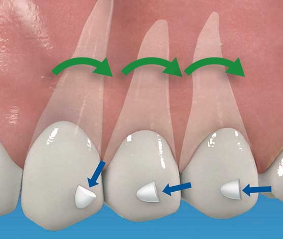 Schéma technique : force douce appliquée par un appareil dentaire de nuit, matériaux et ajustement sur mesure.